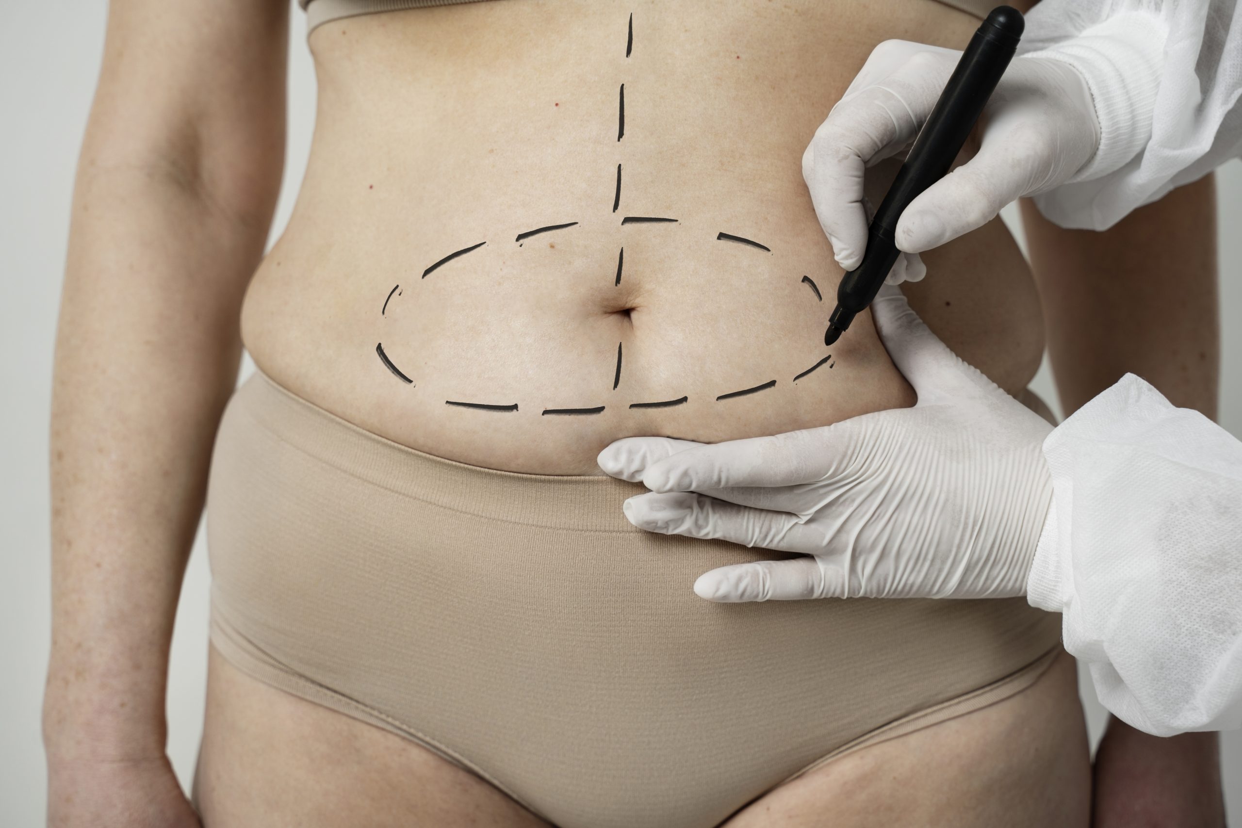 The Top 10 Areas People Get Liposuction and Why